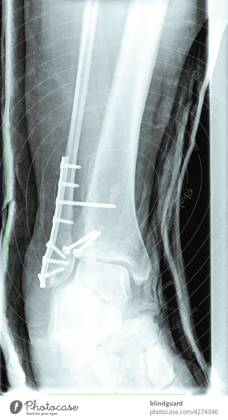 broken leg x ray